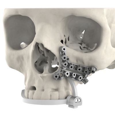 3D Systems Debuts Hybrid-Material Guides for Maxillofacial S...