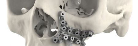 3D Systems Debuts Hybrid-Material Guides for Maxillofacial Surgeries